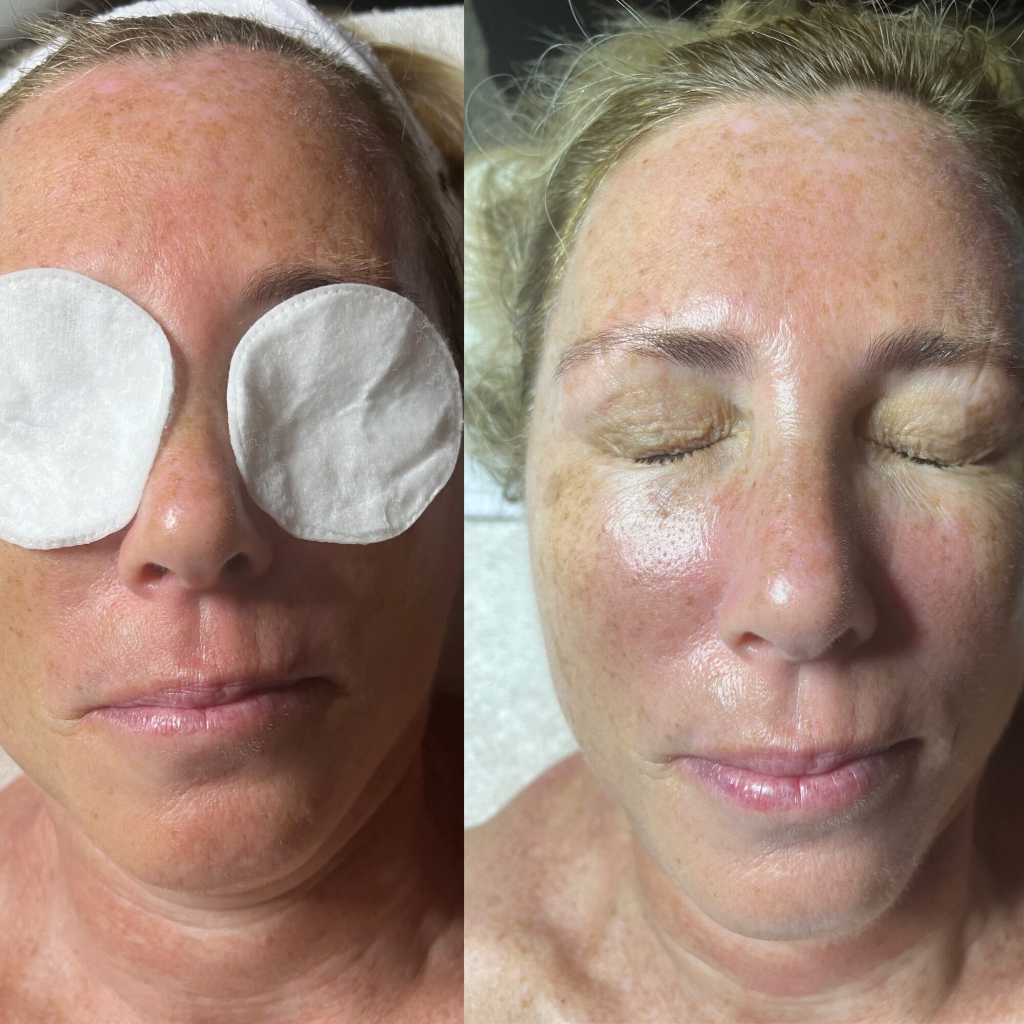 Side-by-side images of a woman with closed eyes, showing skin improvement, one with eye pads, the other without, smiling.